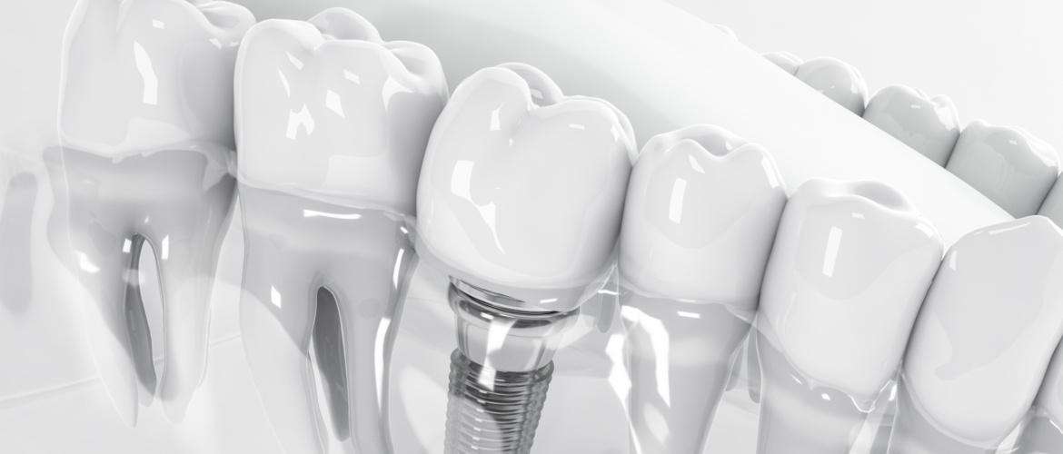 Spotlight On 3D Printing: An Interview with SprintRay’s Mike Baker